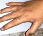 GPs warn students as ‘very infectious’ scabies cases spike across north of England